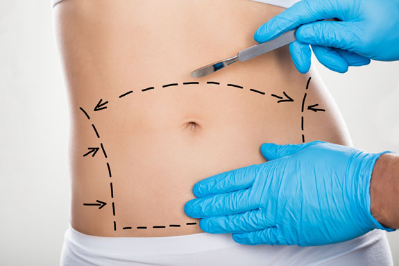 Abdominoplastik Mettmann